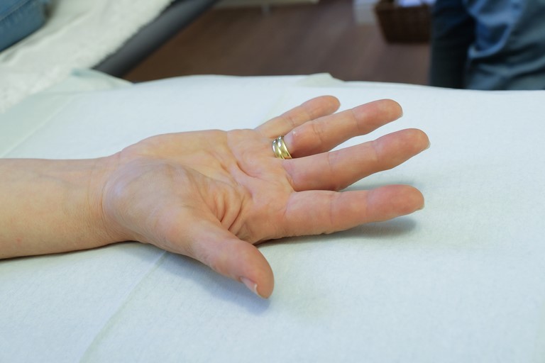 Voor de behandeling:  Aangetaste ringvinger met lichte flexiecontracuur